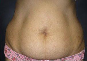 Tummy Tuck Before & After Image