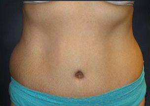 Tummy Tuck Before & After Image