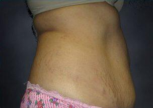 Tummy Tuck Before & After Image