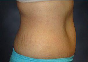 Tummy Tuck Before & After Image