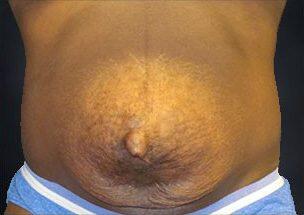 Tummy Tuck Before & After Image