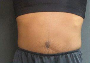 Tummy Tuck Before & After Image