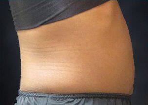 Tummy Tuck Before & After Image