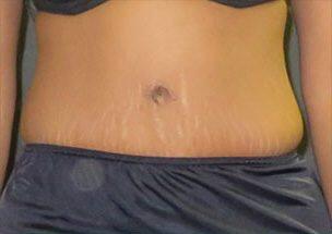 Tummy Tuck Before & After Image