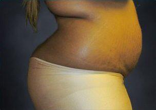 Tummy Tuck Before & After Image