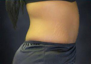 Tummy Tuck Before & After Image