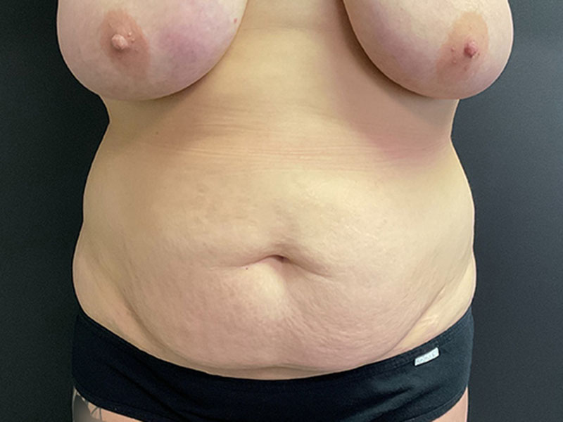 Tummy Tuck Before & After Image