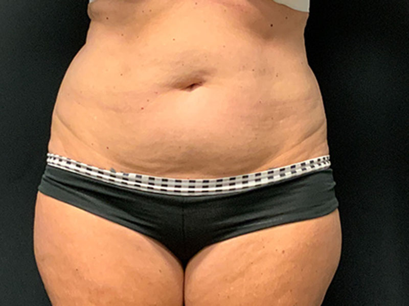 Tummy Tuck Before & After Image