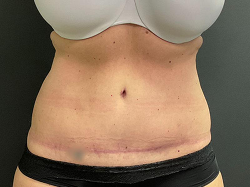 Tummy Tuck Before & After Image