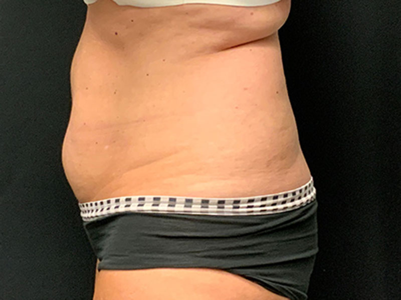 Tummy Tuck Before & After Image