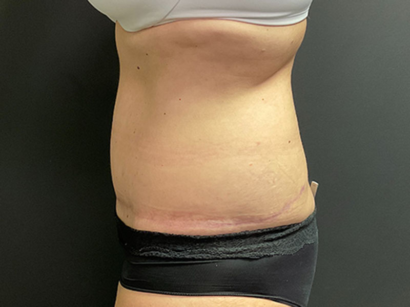 Tummy Tuck Before & After Image