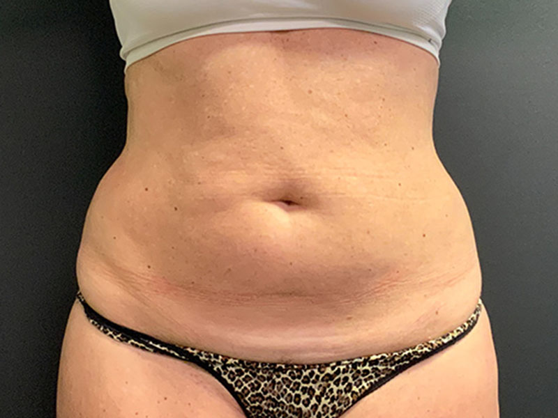 Tummy Tuck Before & After Image