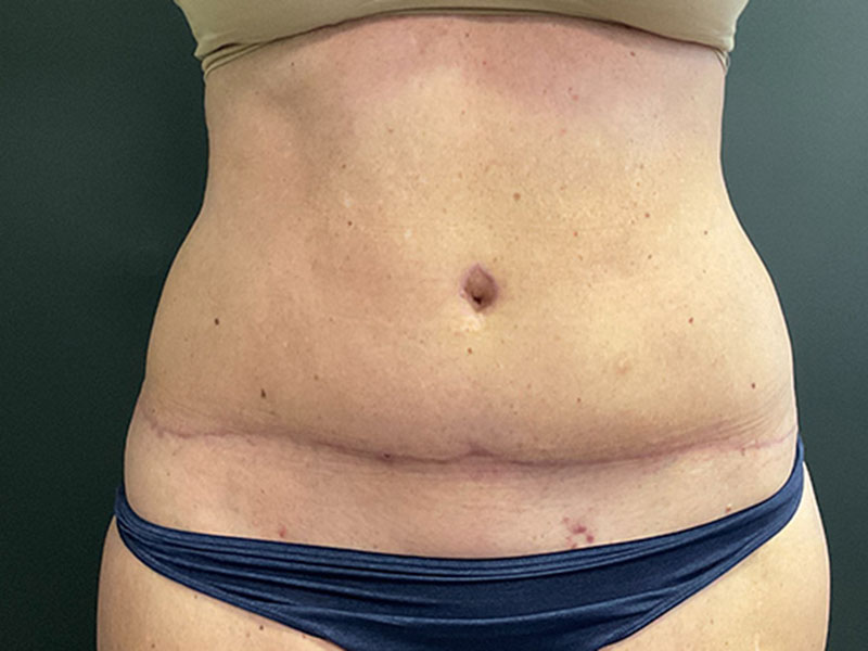 Tummy Tuck Before & After Image
