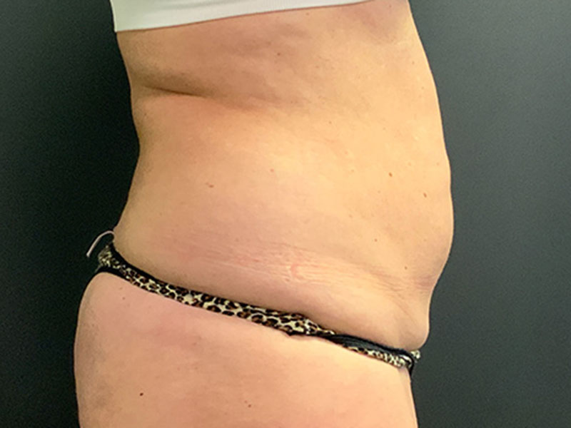 Tummy Tuck Before & After Image