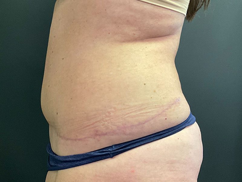 Tummy Tuck Before & After Image