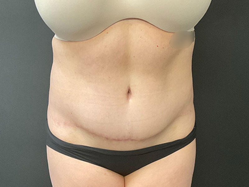 Tummy Tuck Before & After Image