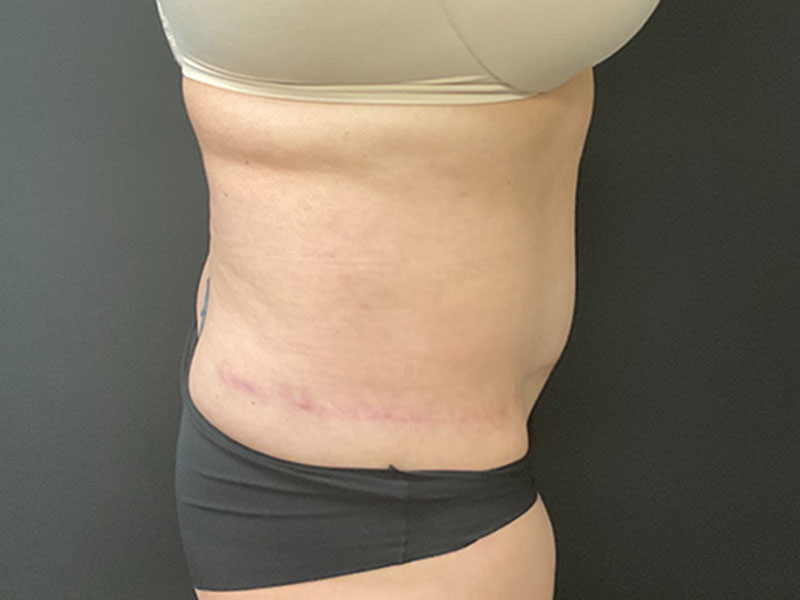 Tummy Tuck Before & After Image