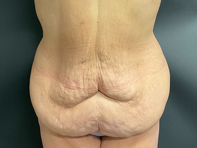 Tummy Tuck Before & After Image