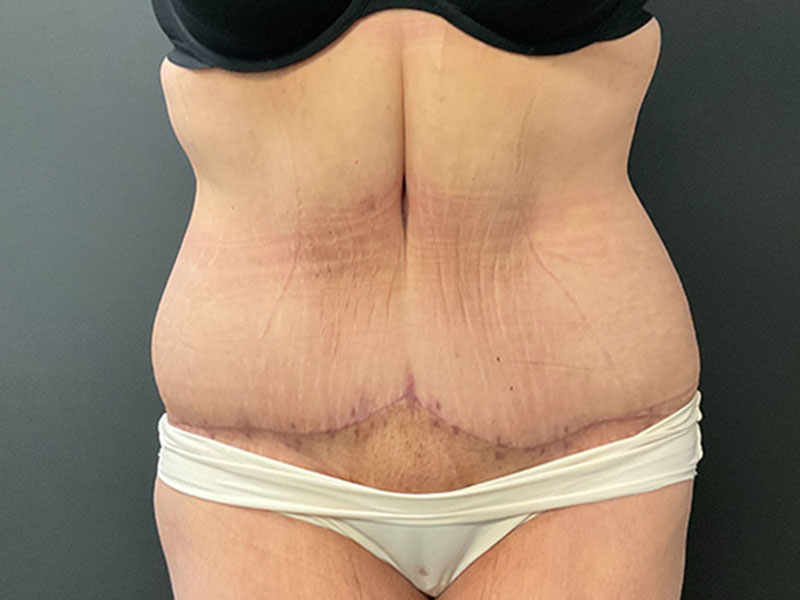Tummy Tuck Before & After Image