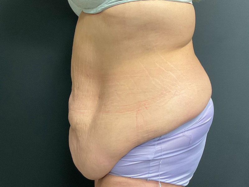 Tummy Tuck Before & After Image