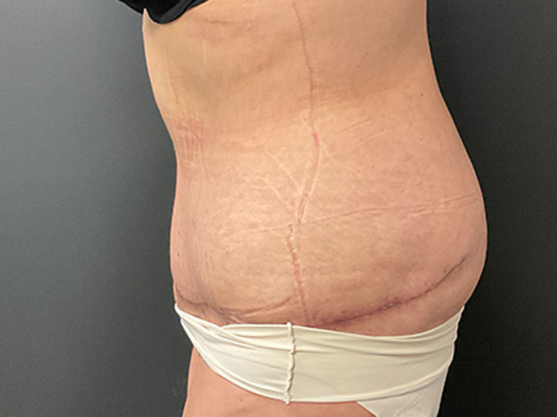 Tummy Tuck Before & After Image