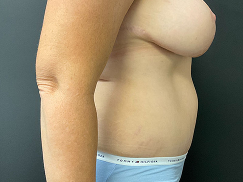 Tummy Tuck Before & After Image