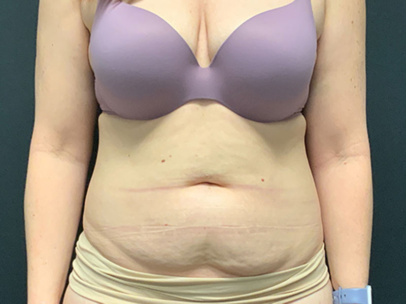 Tummy Tuck Before & After Image