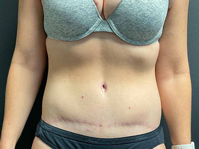 Tummy Tuck Before & After Image