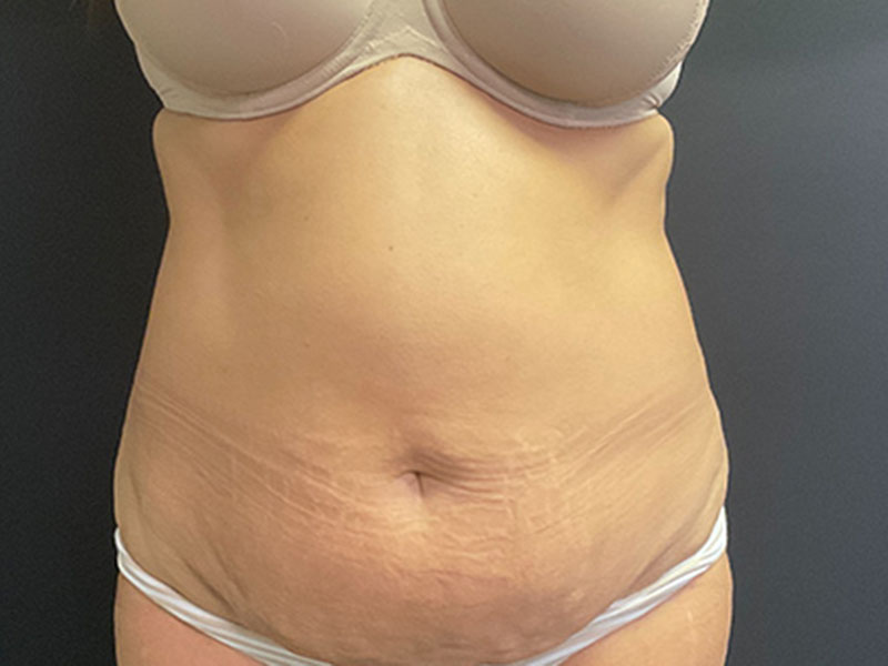 Tummy Tuck Before & After Image