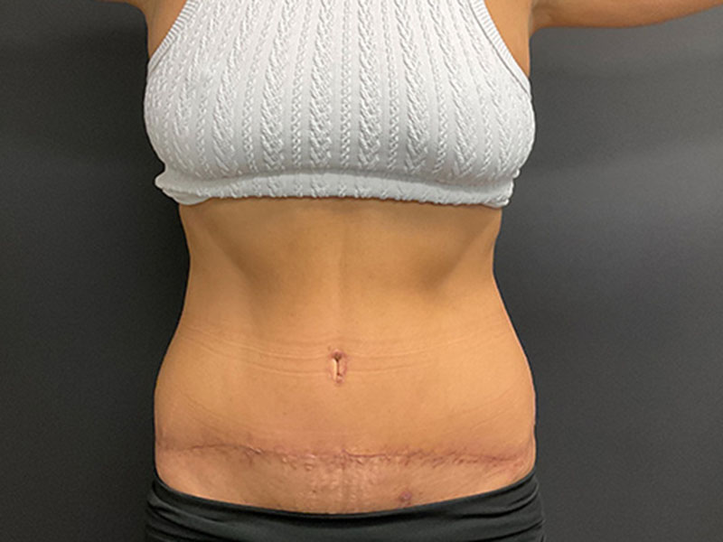 Tummy Tuck Before & After Image