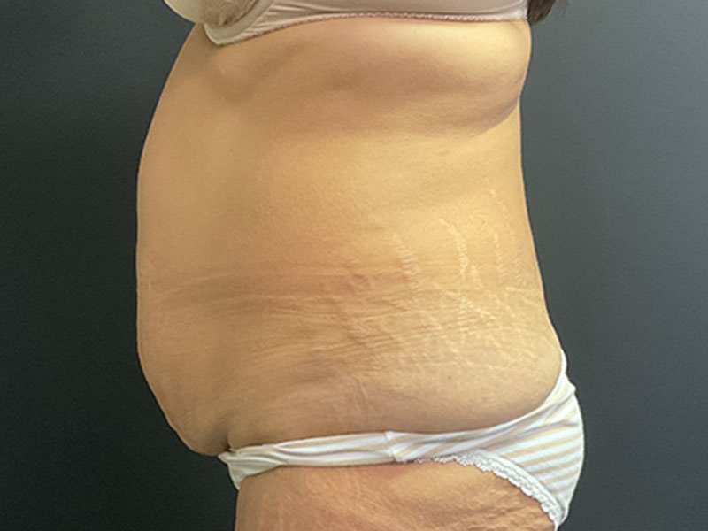 Tummy Tuck Before & After Image