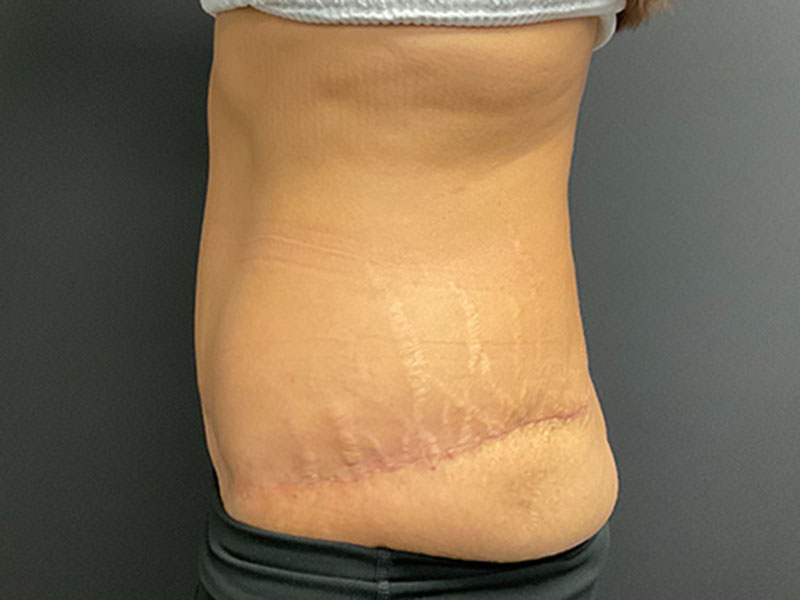 Tummy Tuck Before & After Image
