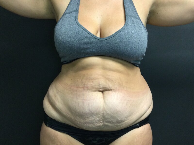 Tummy Tuck Before & After Image
