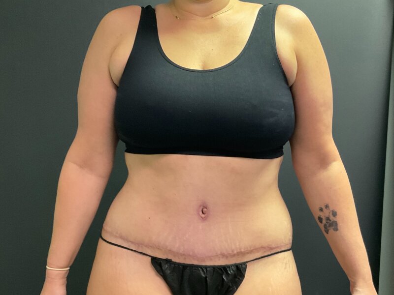 Tummy Tuck Before & After Image