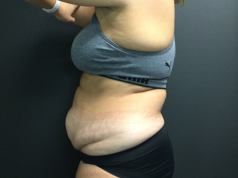 Tummy Tuck Before & After Image