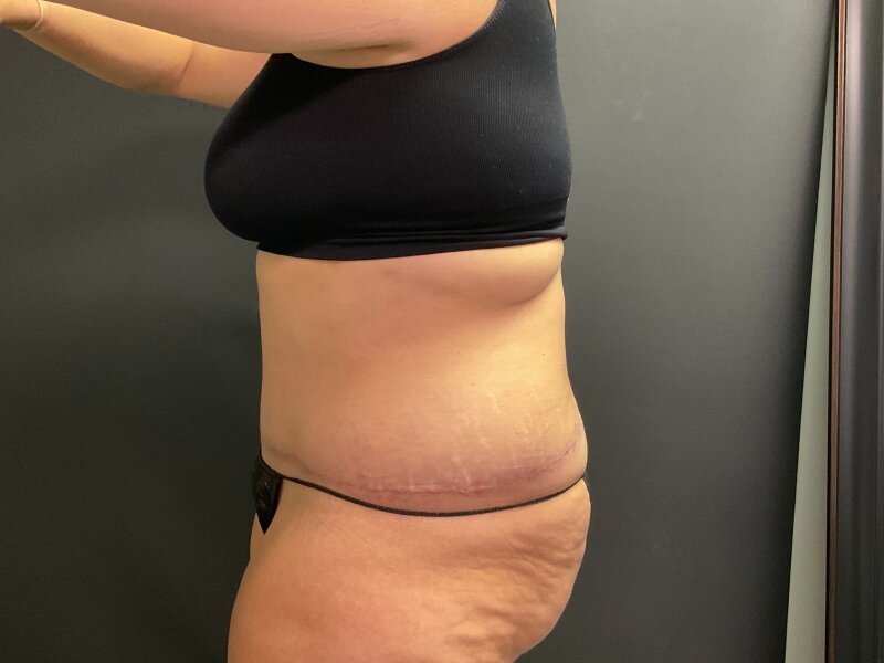 Tummy Tuck Before & After Image