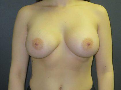 Breast Augmentation Before & After Image