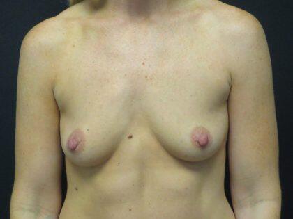 Breast Augmentation Before & After Image