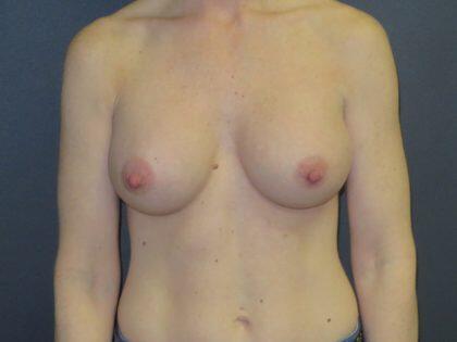 Breast Augmentation Before & After Image