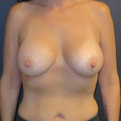 Breast Augmentation Before & After Image