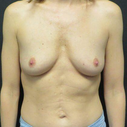 Breast Augmentation Before & After Image