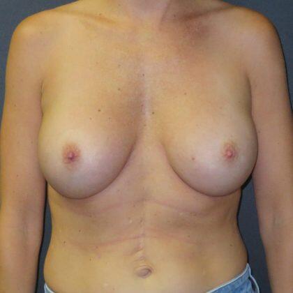 Breast Augmentation Before & After Image