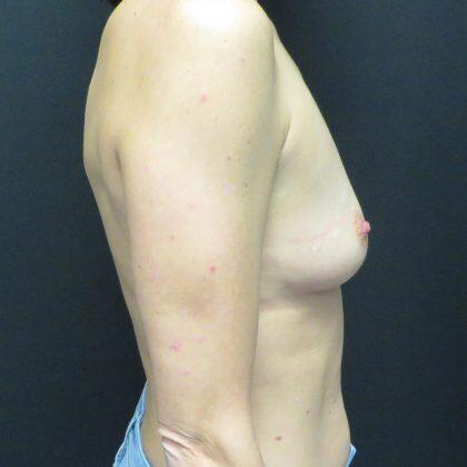 Breast Augmentation Before & After Image