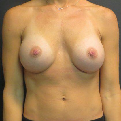 Breast Augmentation Before & After Image