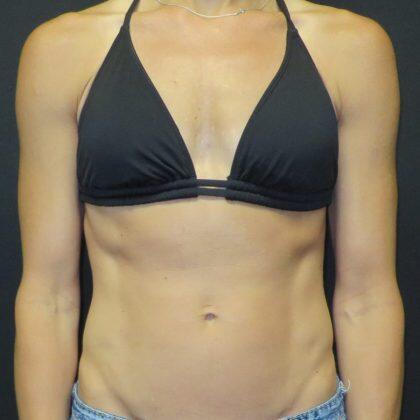 Breast Augmentation Before & After Image