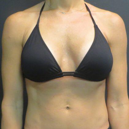 Breast Augmentation Before & After Image