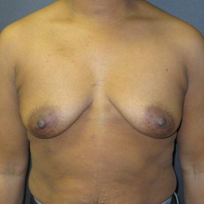 Breast Augmentation Before & After Image