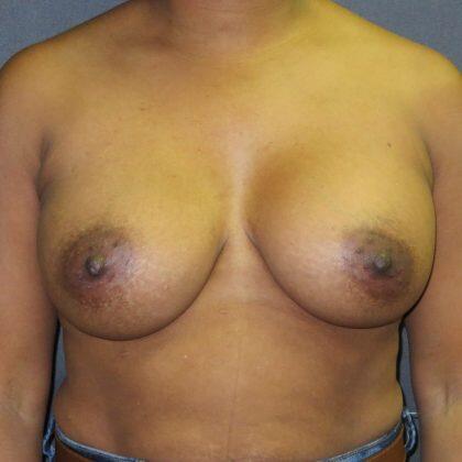 Breast Augmentation Before & After Image