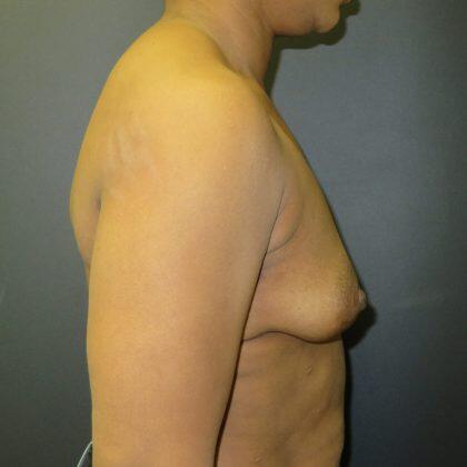 Breast Augmentation Before & After Image