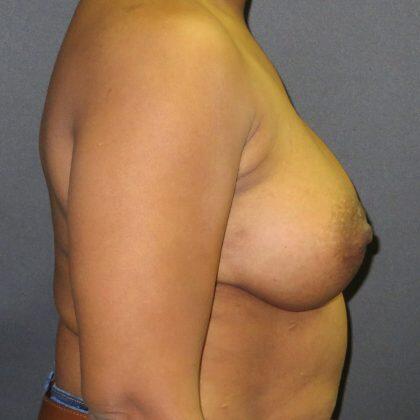 Breast Augmentation Before & After Image